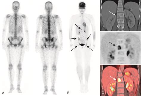 Breast Cancer Metastases-Bone | PracticeUpdate