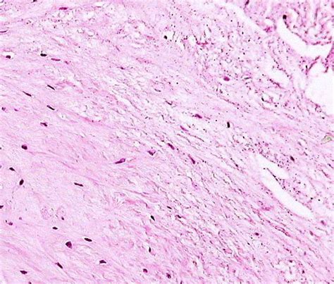 Microscopic aspect of a third degree chondral lesion, to a 55-year-old ...