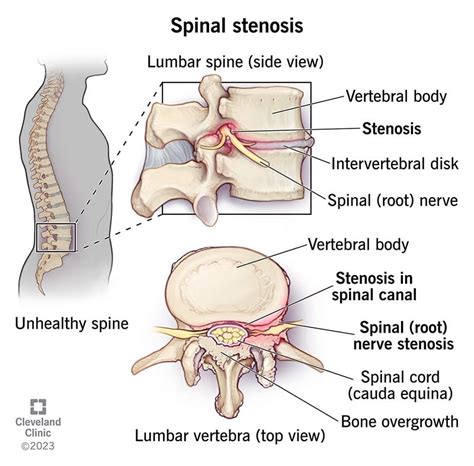 Spinal Stenosis: What It Is, Causes, Symptoms & Treatment