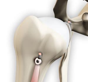 Proximal Biceps Tenodesis | Advanced Orthopaedics & Sports Medicine ...