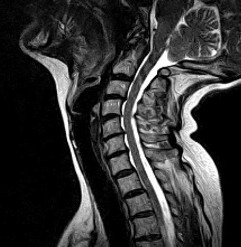 Cervical Spine MRI scan | Medserena Open MRI