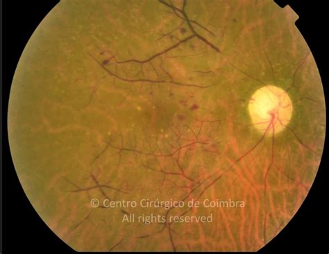 Ocular ischemic syndrome (OIS) is a state of ocular hypoperfusion ...