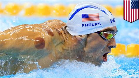 Rio Olympics: Michael Phelps’ cupping therapy marks becoming a trend ...