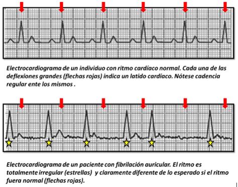 Mordrin proteger clase fibrilacion auricular arritmia Nombre ...