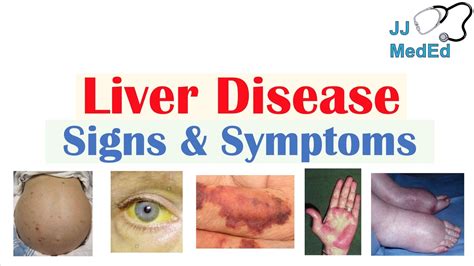 Pictures Of Cirrhosis Of The Liver Symptoms - the meta pictures