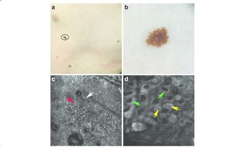 Spitz nevus localized on the trunk (a). Dermoscopy showed a globular ...