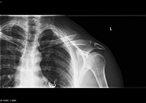 Clavicle fracture (X-Ray) - radRounds Radiology Network