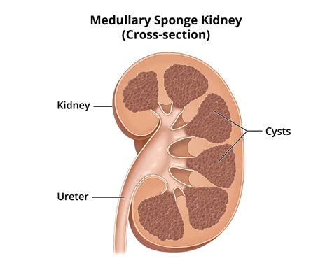 Medullary Sponge Kidney - NIDDK