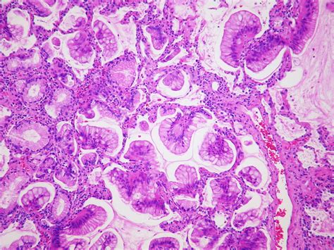 Adenocarcinoma: Mucinous Adenocarcinoma