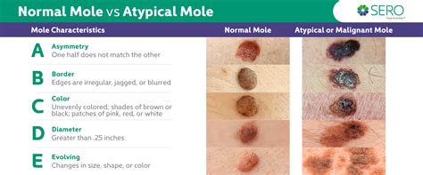 Benign Nevus Vs Melanoma