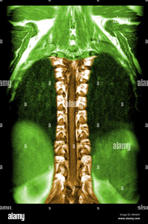 MRI of Normal Thoracic Spinal Cord Stock Photo - Alamy