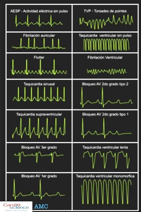 Electrocardiograma Ecg Ecg Con Arritmia Cardiaca Imagen De Archivo ...