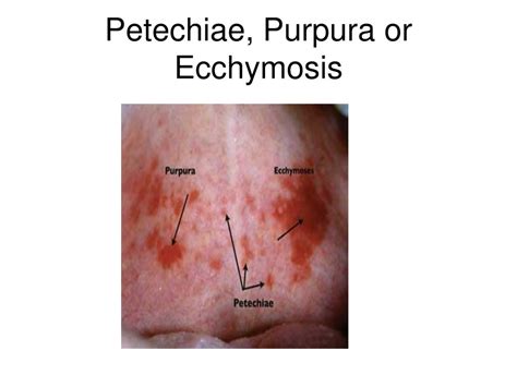 Petechiae Purpura Ecchymosis Size