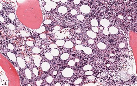 Bone Marrow Biopsy 1