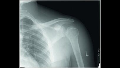 Hemiplegic Shoulder Subluxation - Physiopedia