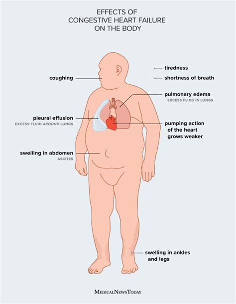 Congestive Heart Failure Water Balance - BEST GAMES WALKTHROUGH