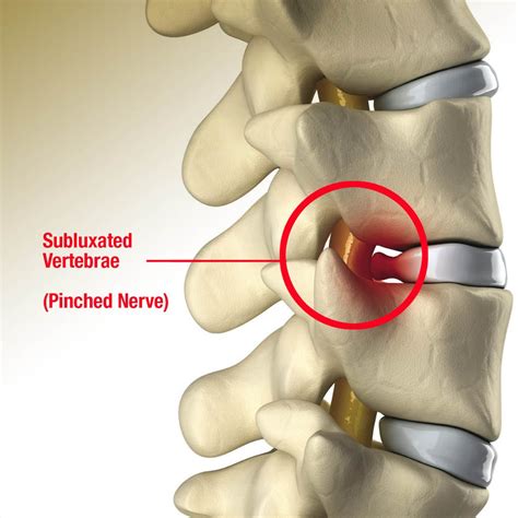 PINCHED NERVES - Innovative Therapy Canada.