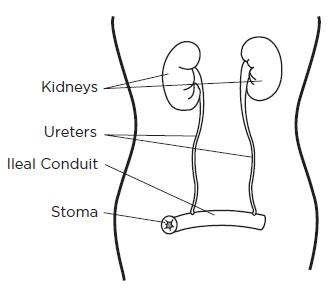 About Your Bladder Surgery with an Ileal Conduit (Urostomy) | Memorial ...