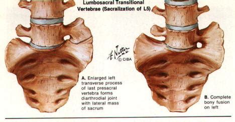 Lumbar sacralization