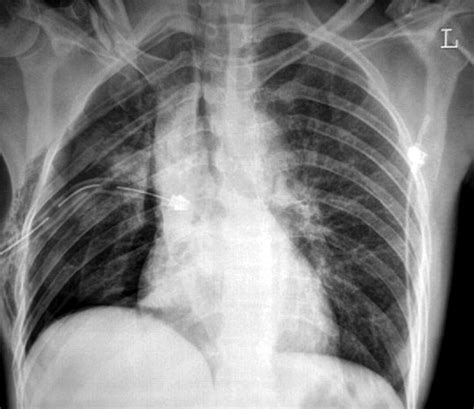 Tension pneumothorax and the “forbidden CXR” | Emergency Medicine Journal