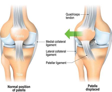 Chondromalacia Patella Treatment Specialist