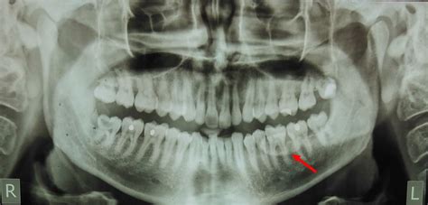 Peripheral osteoma of the mandible | BMJ Case Reports