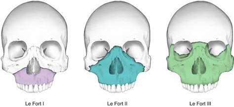 Facial fractures causes, types, symptoms, diagnosis, treatment & recovery