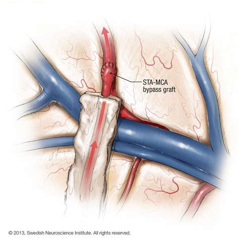 Moyamoya Disease - SeattleNeurosciences.com