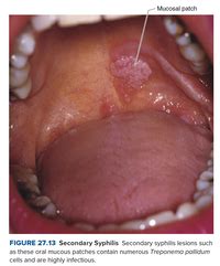 Answered: Mucosal patch FIGURE 27.13 Secondary… | bartleby