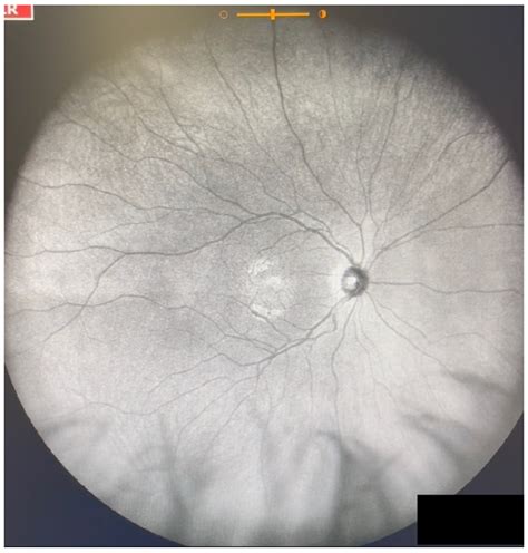 JCM | Free Full-Text | Visualization and Grading of Vitreous Floaters ...