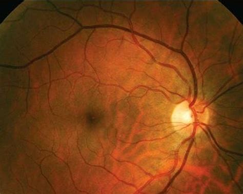 Optic Neuritis - Pictures, Symptoms, Causes, Diagnosis, Treatment ...