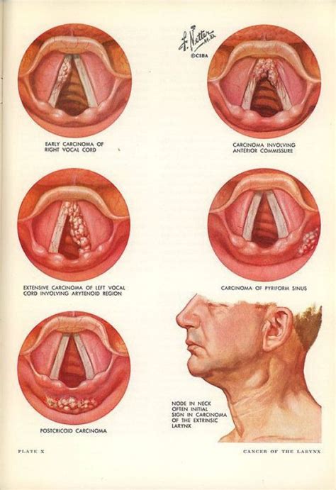 vocal fold pathology - Google Search #craniosacraltherapy #craniosacral ...