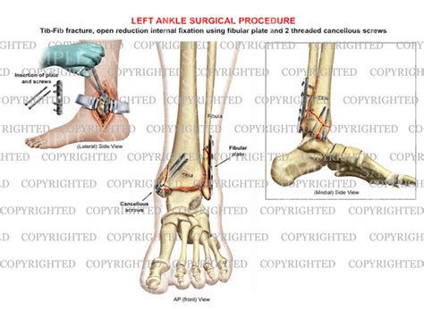 ORIF surgery of bimalleolar tib-fib fracture — Medical Art Works