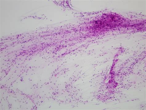 Pilocytic Astrocytoma Cytology – Adventures in Neuropathology