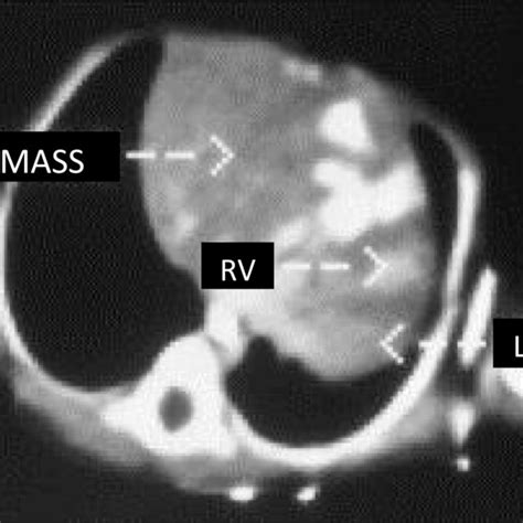 Chest radiograph 24 hours after repair of Bochdalek hernia. The grossly ...