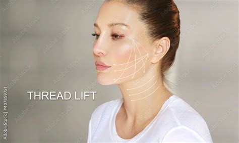 Thread Lift ,markup, thread-lift procedure for facial rejuvenation ...