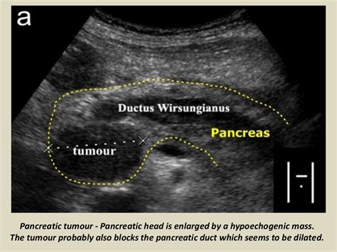 Ultrasound of pancrease in Radiology