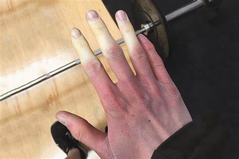 Drug-induced Raynaud’s phenomenon ‘probably underestimated’ - The ...