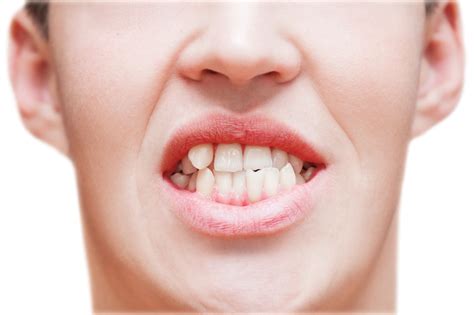 Crooked Teeth: Causes, Impact, and Treatment