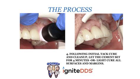 What Dental Cement Should I Use?: igniteDDS Case Study