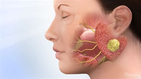 Parotid Tumor: Overview - ENTJC