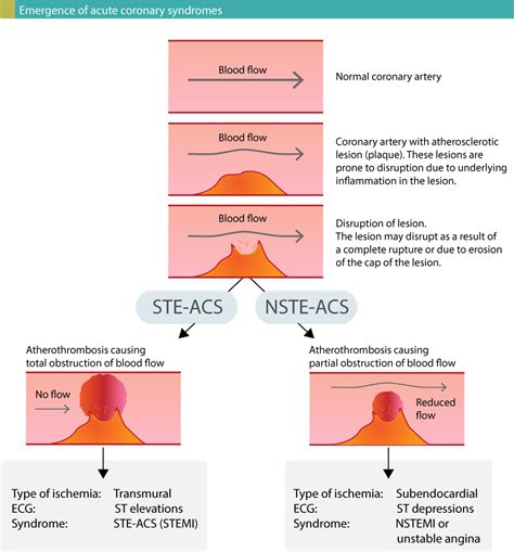 NSTEMI (Non ST Elevation Myocardial Infarction) & Unstable Angina ...