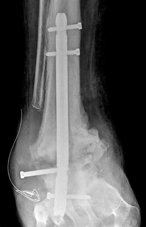 arthrodesis | The Foot and Ankle Online Journal