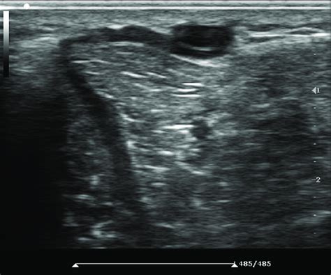 Ultrasound color duplex scan showing perforator vein | Download ...