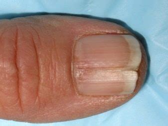 Allergy to gel polish (32 photos): symptoms and causes, list of ...