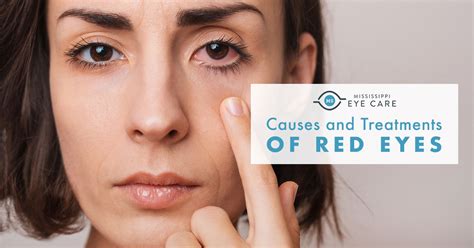 Causes and Treatments of Red Eyes - Mississippi Eye Care