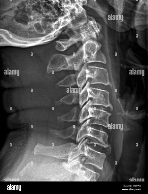 Cervical Spine Osteoarthritis