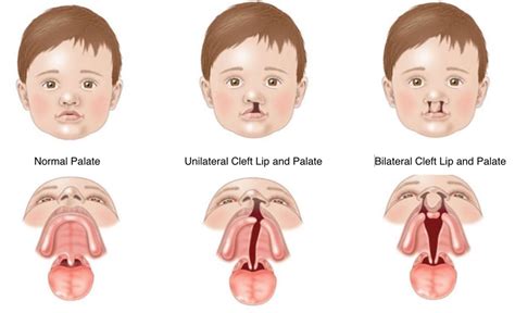 Cleft Lip and Cleft Palate | Vikram ENT Hospital