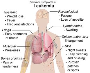 Leukemia - Wikipedia