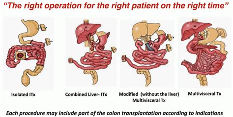 Chronic Intestinal Pseudo-obstruction Syndrome: Surgical Approach and ...